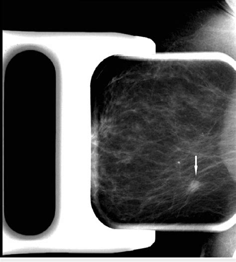 spot compression test|what is spot compression mammogram.